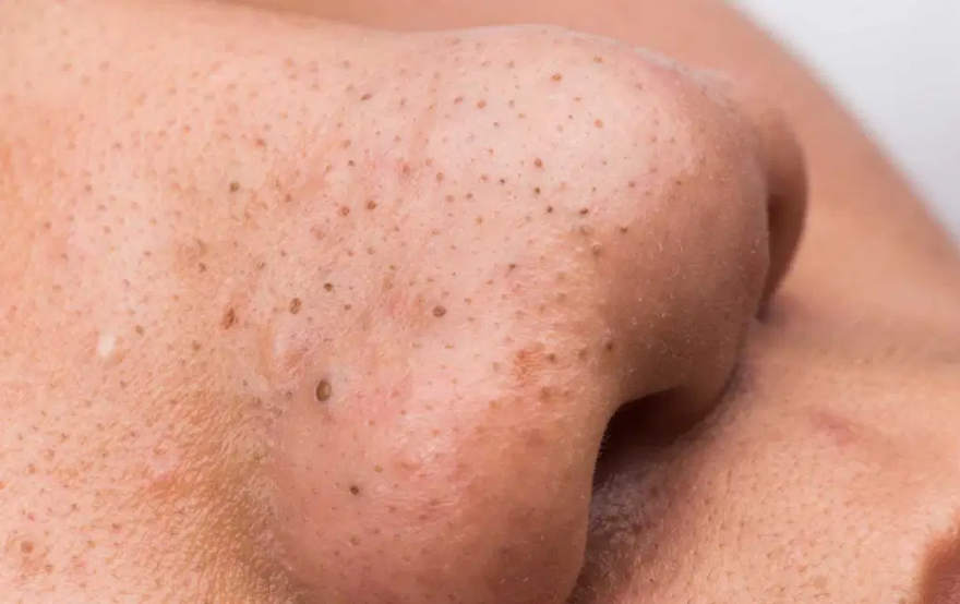 blackhead